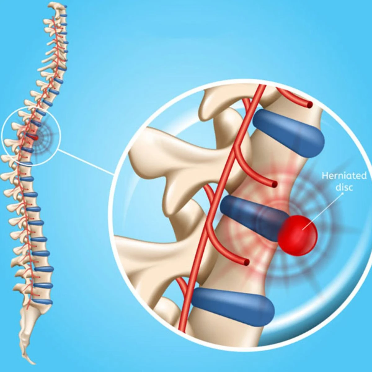 Phẫu thuật điều trị thoát vị đĩa đệm khi điều trị nội khoa không còn hiệu quả