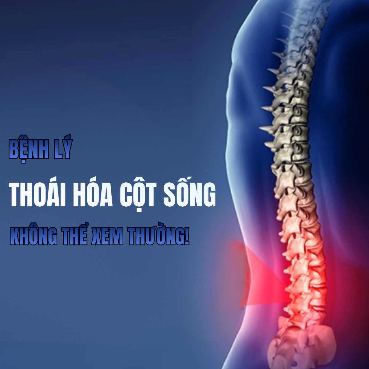 Thoái Hóa Cột Sống - Phương Pháp Trị Liệu Chuẩn Y Khoa, Cải Thiện Tận Gốc