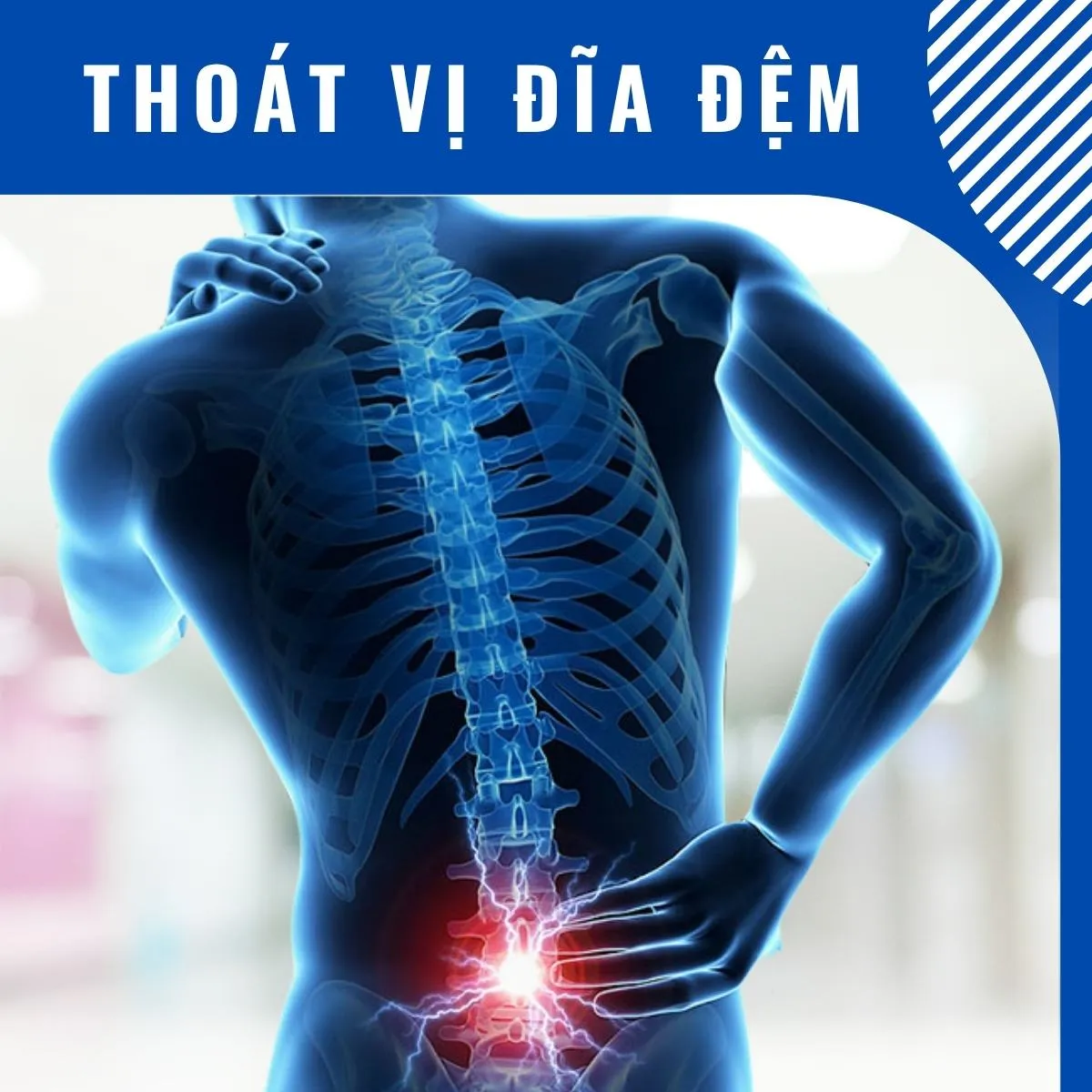 Thoát vị đĩa đệm - Phương pháp trị liệu được bác sĩ chuyên khoa khuyến cáo