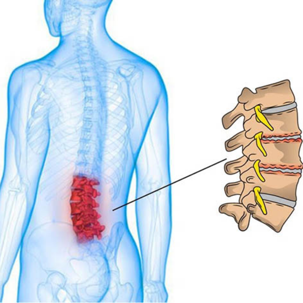 Tìm hiểu cơ bản về bệnh lý thoái hóa cột sống